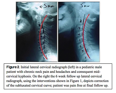 Pediatric cervical lordosis values can vary from that of the adult due to 